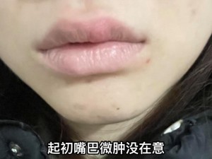 为什么头被老嘴咬了肿了？如何快速消肿？