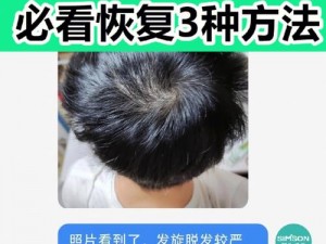 男性黑人如何解决脱发问题？