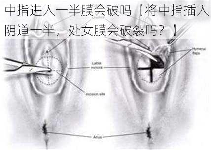 中指进入一半膜会破吗【将中指插入阴道一半，处女膜会破裂吗？】